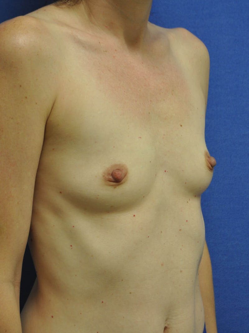 Breast Augmentation Before & After Gallery - Patient 90027281 - Image 3