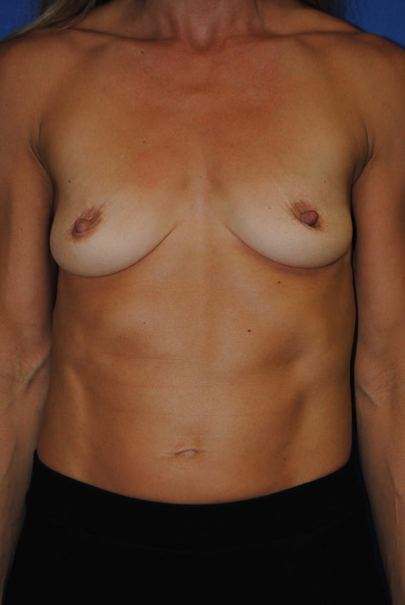 Breast Augmentation Before & After Gallery - Patient 90027313 - Image 1