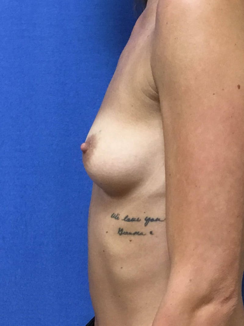 Breast Augmentation Before & After Gallery - Patient 90027315 - Image 3
