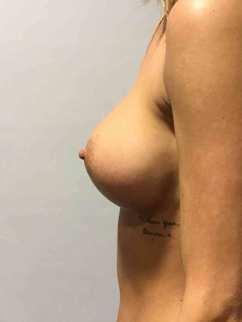 Breast Augmentation Before & After Gallery - Patient 90027315 - Image 4