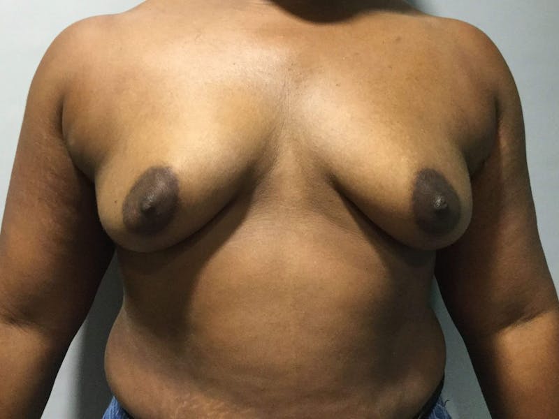 Breast Augmentation Before & After Gallery - Patient 90027621 - Image 1