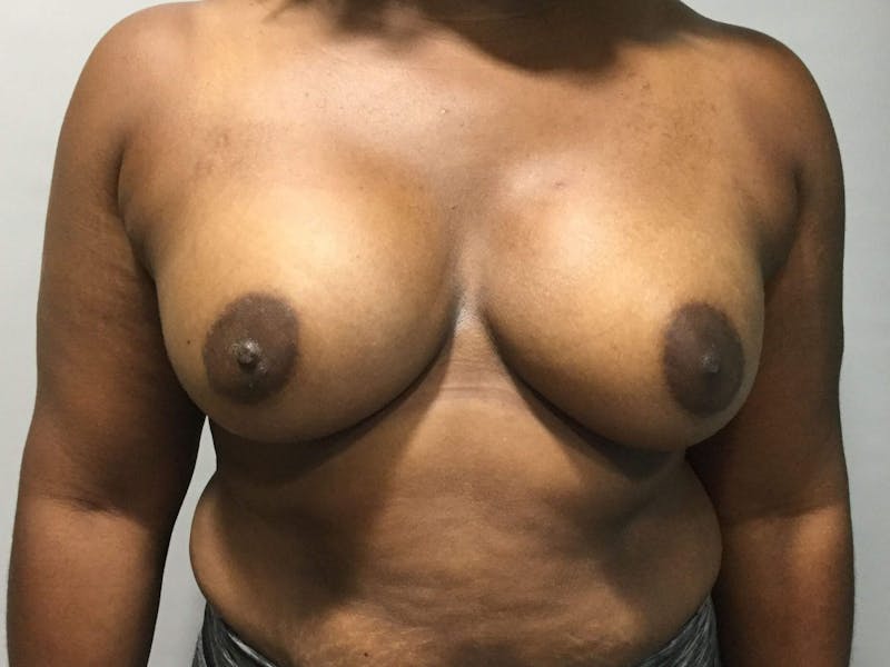 Breast Augmentation Before & After Gallery - Patient 90027621 - Image 2