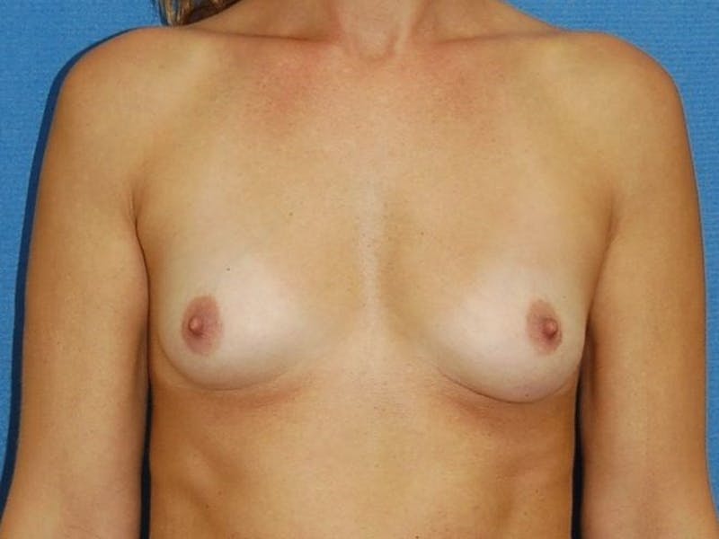 Breast Augmentation Before & After Gallery - Patient 90027622 - Image 1