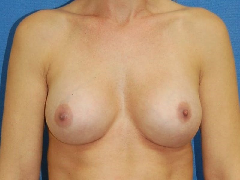 Breast Augmentation Before & After Gallery - Patient 90027622 - Image 2