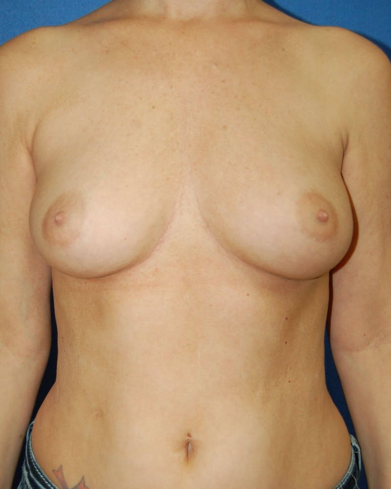 Breast Augmentation Before & After Gallery - Patient 90364937 - Image 1