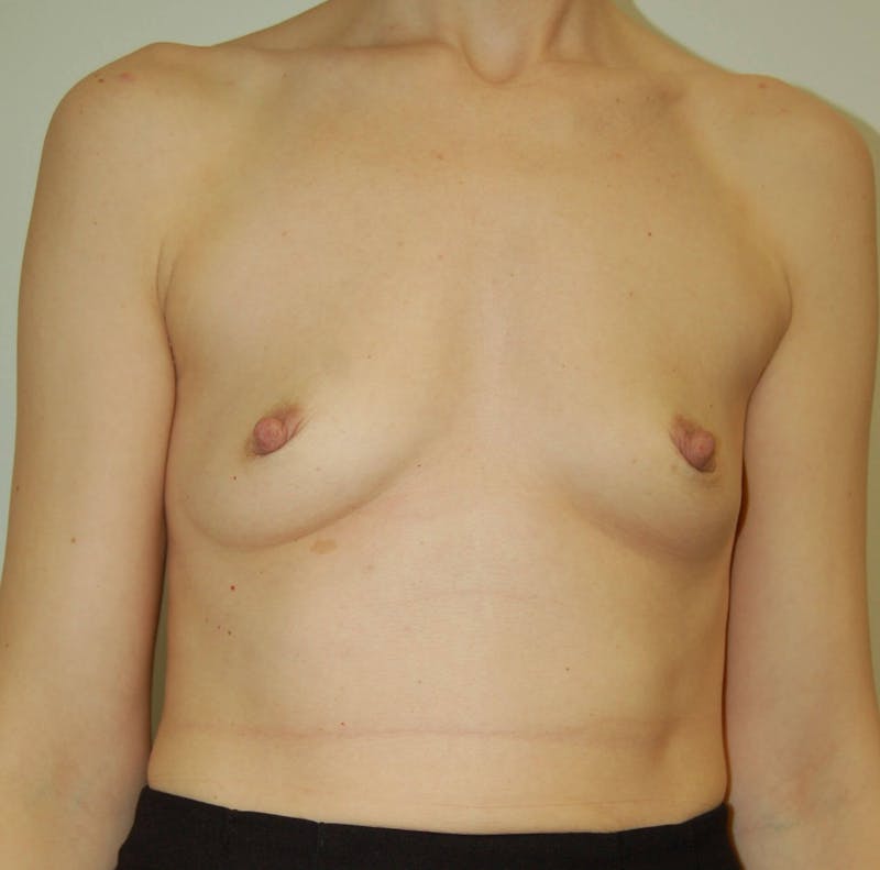 Breast Augmentation Before & After Gallery - Patient 90364943 - Image 1