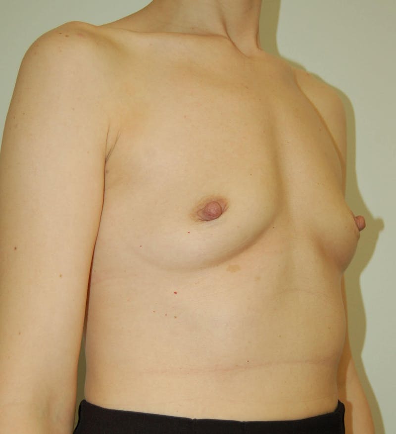 Breast Augmentation Before & After Gallery - Patient 90364943 - Image 3