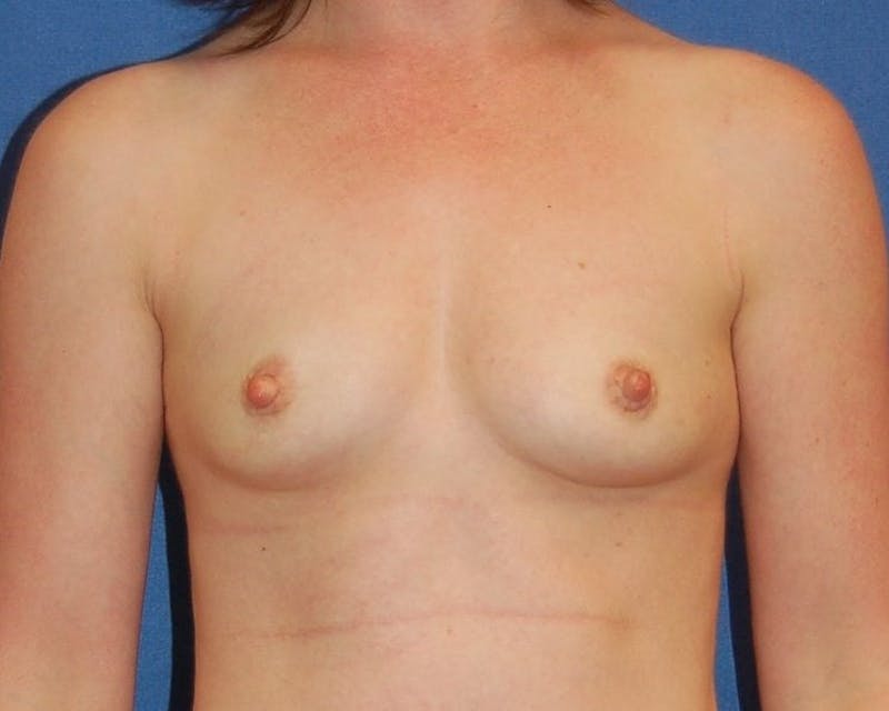Breast Augmentation Before & After Gallery - Patient 90379348 - Image 1