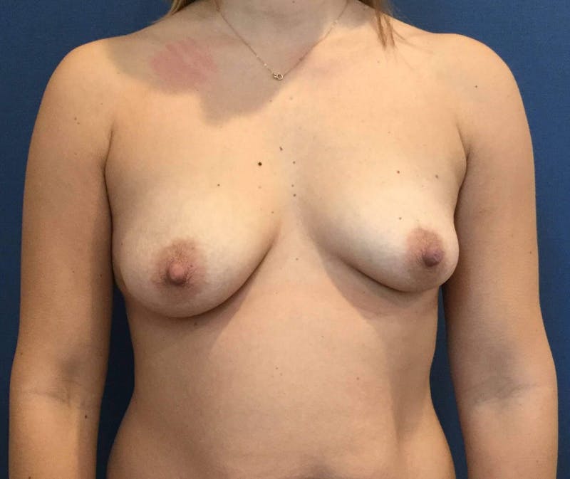 Breast Augmentation Before & After Gallery - Patient 90379407 - Image 1