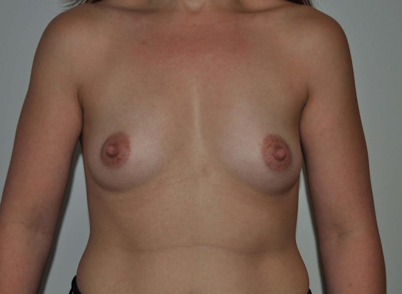 Breast Augmentation Before & After Gallery - Patient 90381007 - Image 1