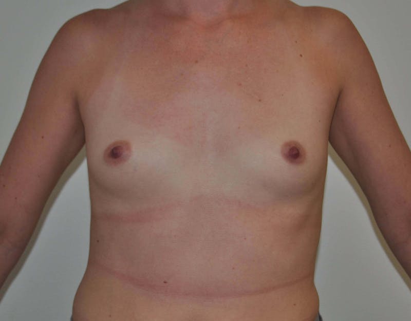 Breast Augmentation Before & After Gallery - Patient 90381015 - Image 1