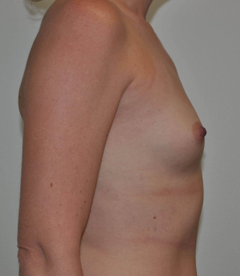 Breast Augmentation Before & After Gallery - Patient 90381015 - Image 3