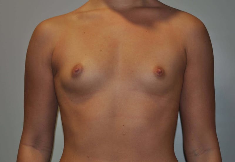 Breast Augmentation Before & After Gallery - Patient 90381017 - Image 1