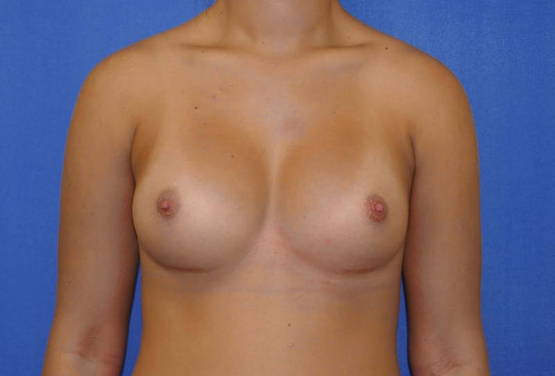 Breast Augmentation Before & After Gallery - Patient 90381017 - Image 2