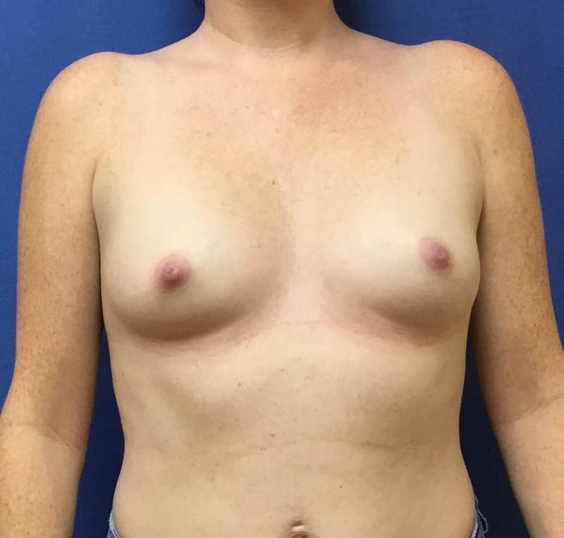 Breast Augmentation Before & After Gallery - Patient 90381018 - Image 1