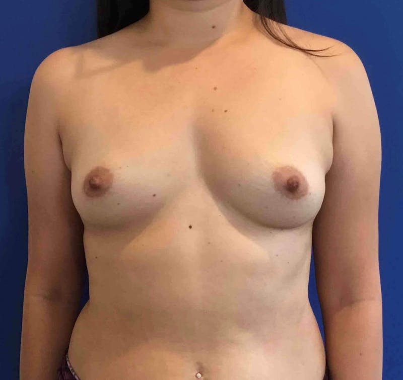 Breast Augmentation Before & After Gallery - Patient 90381028 - Image 1