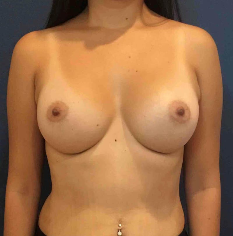 Breast Augmentation Before & After Gallery - Patient 90381028 - Image 2