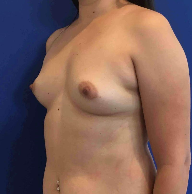 Breast Augmentation Before & After Gallery - Patient 90381028 - Image 5