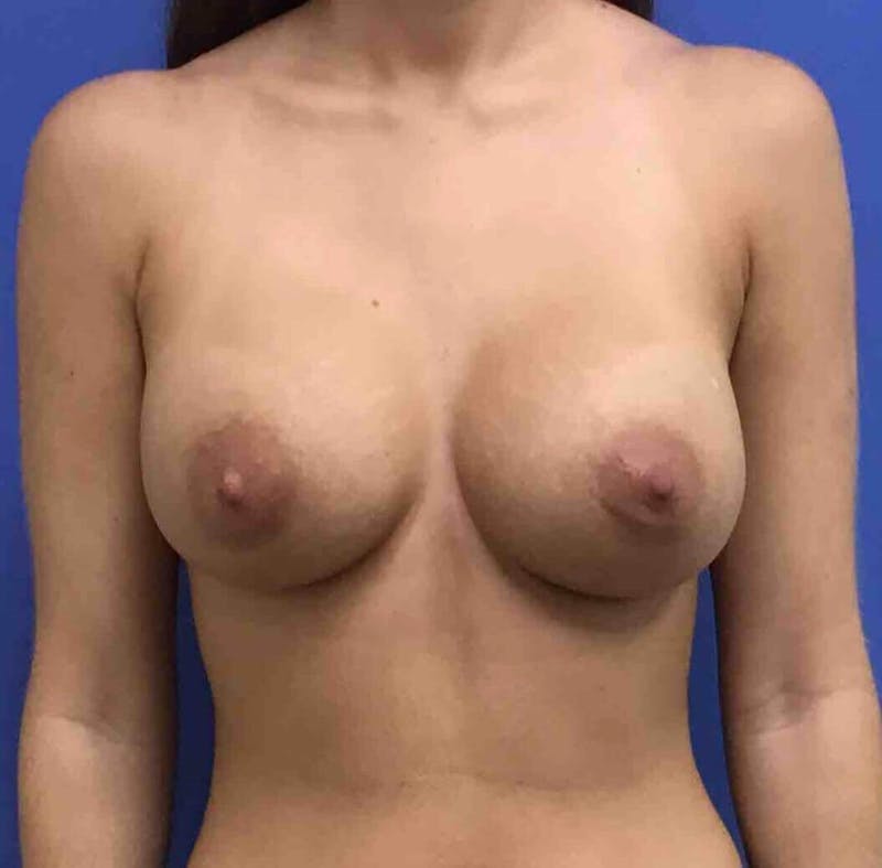 Breast Augmentation Before & After Gallery - Patient 90381047 - Image 2