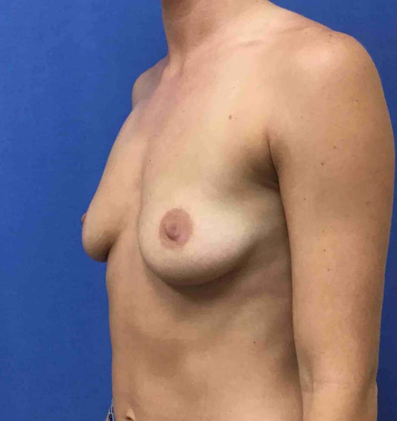 Breast Augmentation Before & After Gallery - Patient 90381057 - Image 3