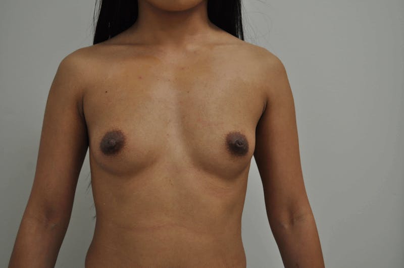 Breast Augmentation Before & After Gallery - Patient 90381072 - Image 1