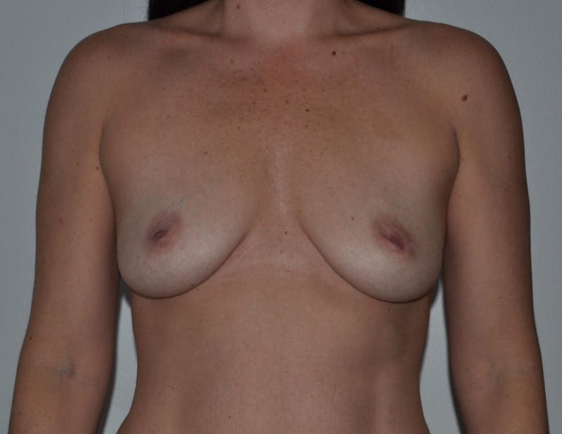 Breast Augmentation Before & After Gallery - Patient 90383350 - Image 1