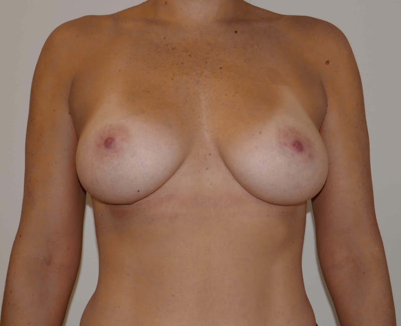 Breast Augmentation Before & After Gallery - Patient 90383350 - Image 2