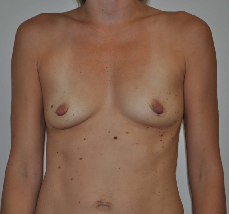 Breast Augmentation Before & After Gallery - Patient 90383354 - Image 1