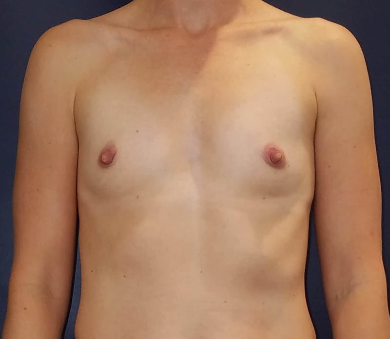 Breast Augmentation Before & After Gallery - Patient 90383357 - Image 1