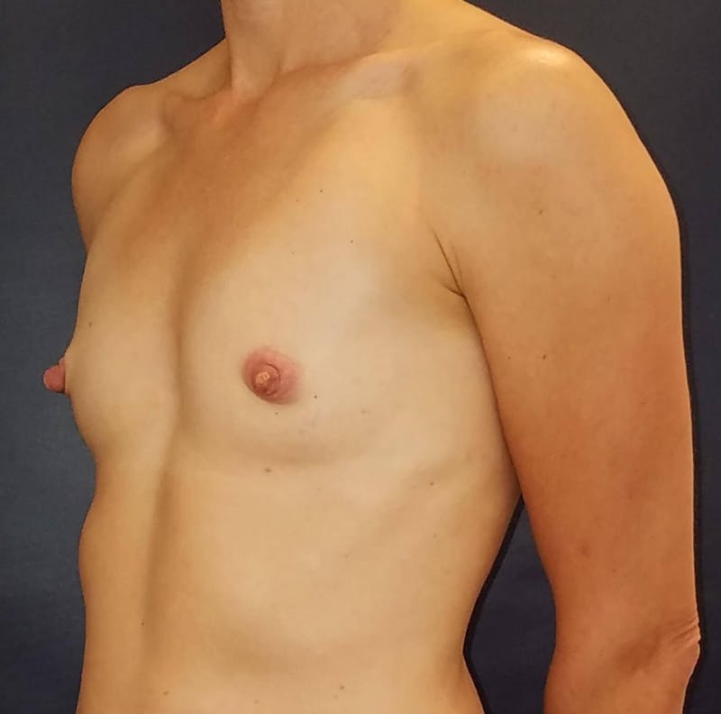 Breast Augmentation Before & After Gallery - Patient 90383357 - Image 3