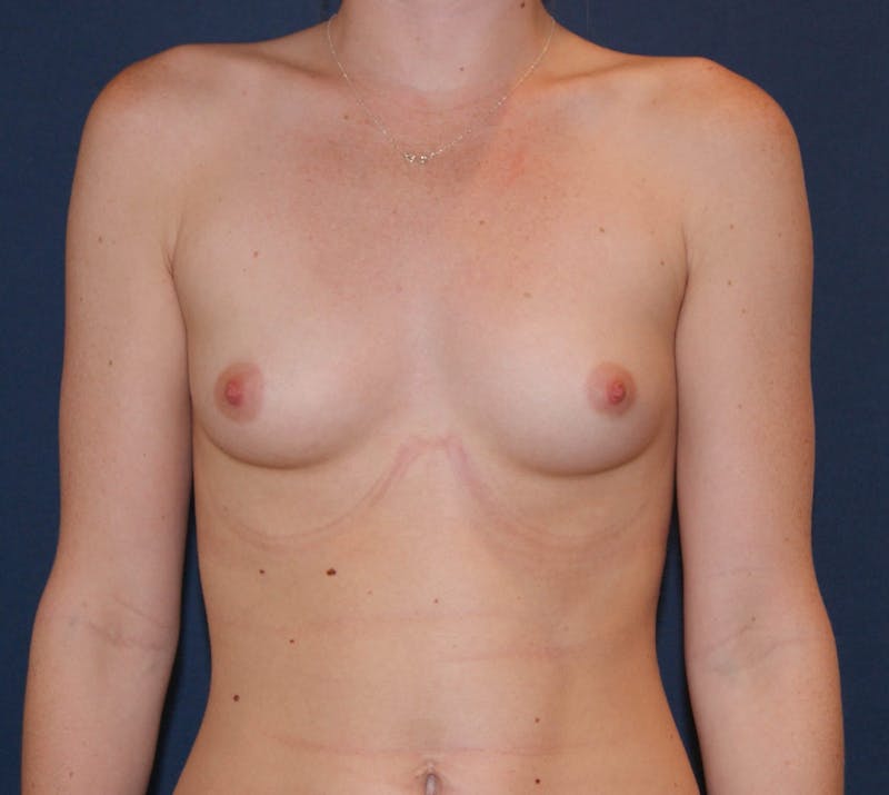 Breast Augmentation Before & After Gallery - Patient 90383375 - Image 1