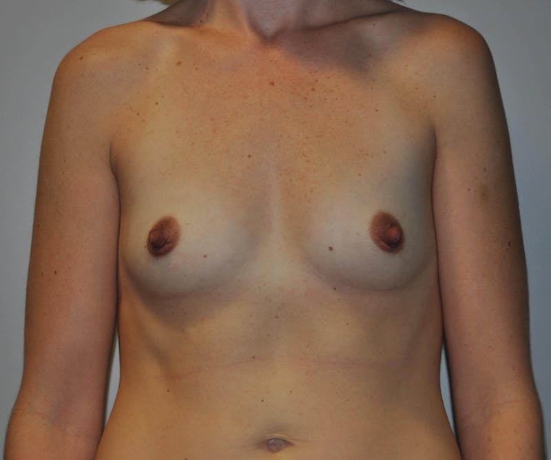Breast Augmentation Before & After Gallery - Patient 90383590 - Image 1