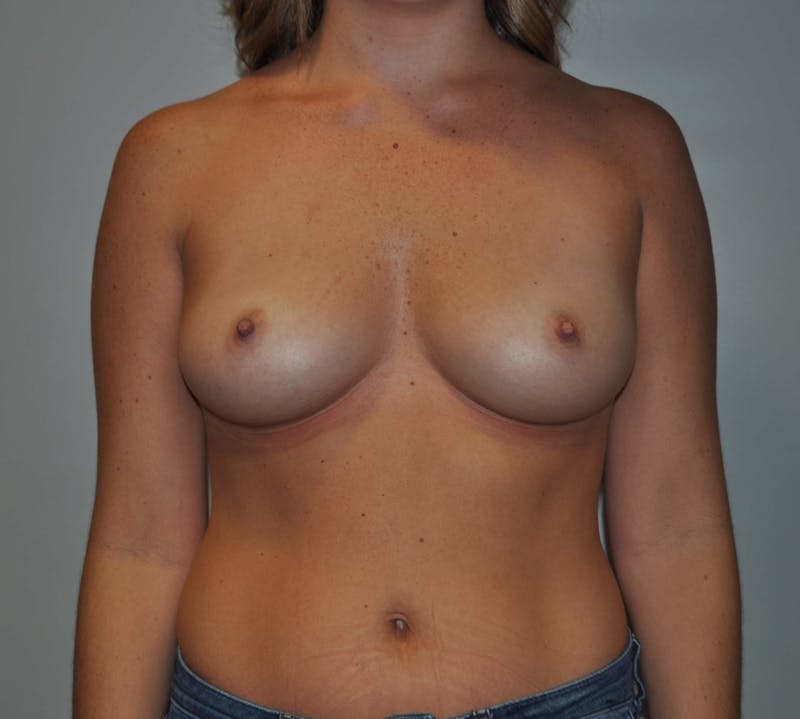 Breast Augmentation Before & After Gallery - Patient 90383635 - Image 1