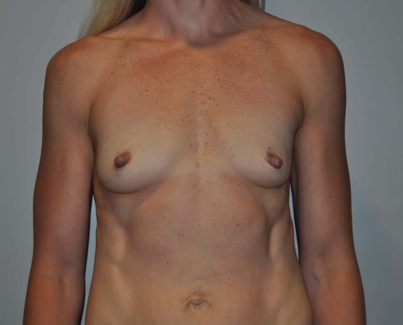 Breast Augmentation Before & After Gallery - Patient 90383673 - Image 1