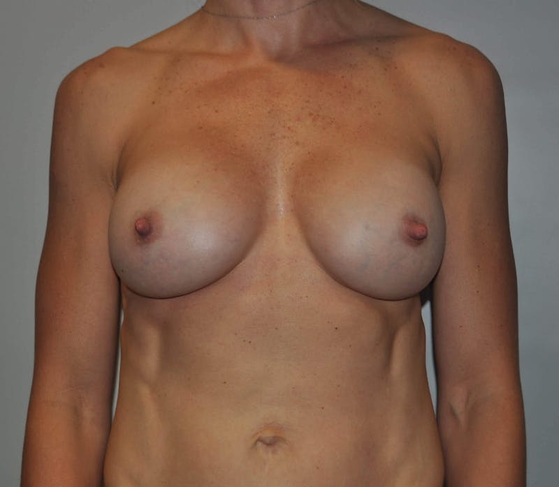 Breast Augmentation Before & After Gallery - Patient 90383673 - Image 2