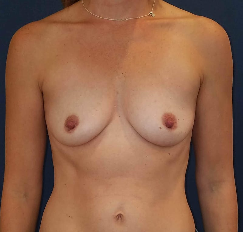 Breast Augmentation Before & After Gallery - Patient 90383711 - Image 1