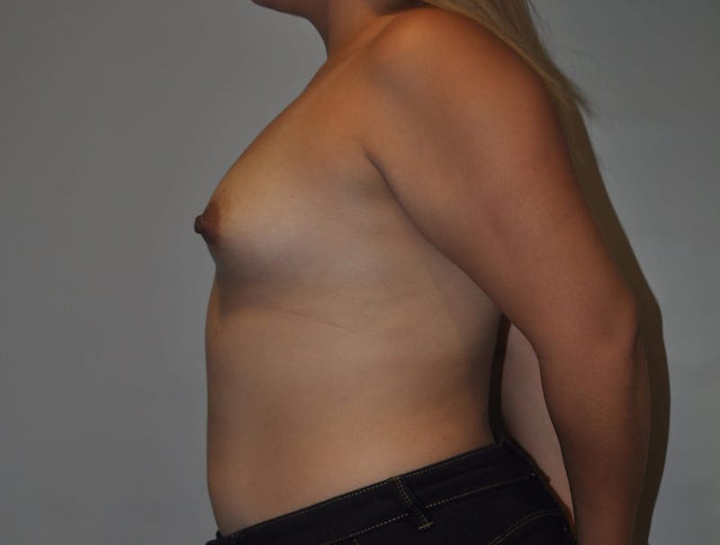 Breast Augmentation Before & After Gallery - Patient 90386029 - Image 3
