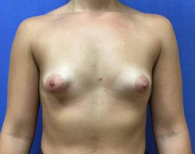 Breast Augmentation Before & After Gallery - Patient 90386048 - Image 1