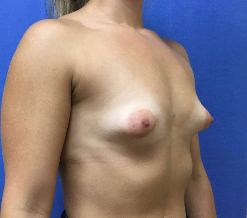 Breast Augmentation Before & After Gallery - Patient 90386048 - Image 5