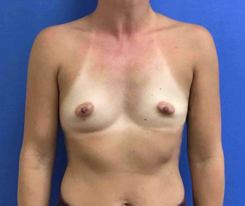 Breast Augmentation Before & After Gallery - Patient 90386056 - Image 1