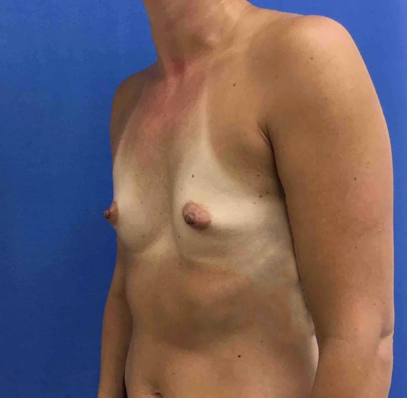 Breast Augmentation Before & After Gallery - Patient 90386056 - Image 3