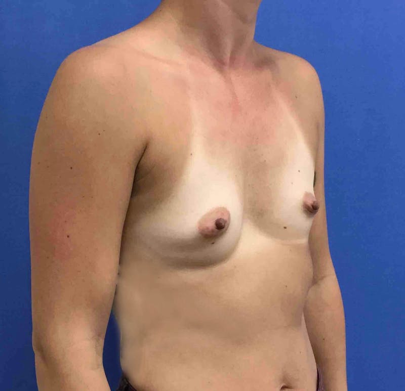 Breast Augmentation Before & After Gallery - Patient 90386056 - Image 5