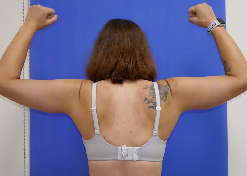 Arm Lift (Brachioplasty) Before & After Gallery - Patient 90401966 - Image 4