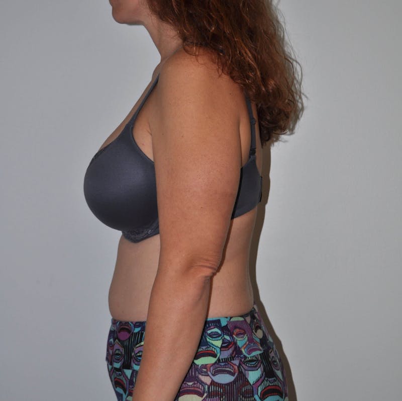 Arm Lift (Brachioplasty) Before & After Gallery - Patient 90401966 - Image 7