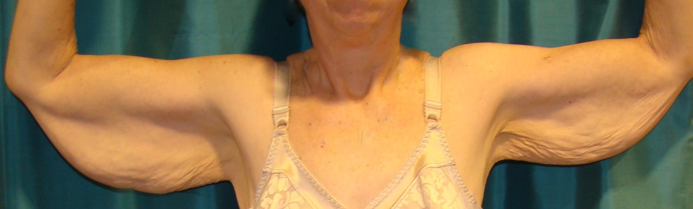 Arm Lift (Brachioplasty) Gallery - Patient 90401987 - Image 1