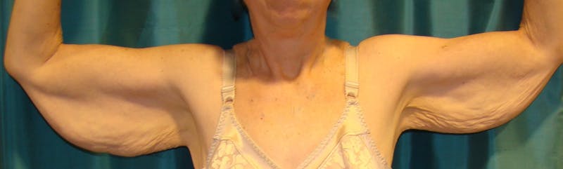 Arm Lift (Brachioplasty) Before & After Gallery - Patient 90401987 - Image 1