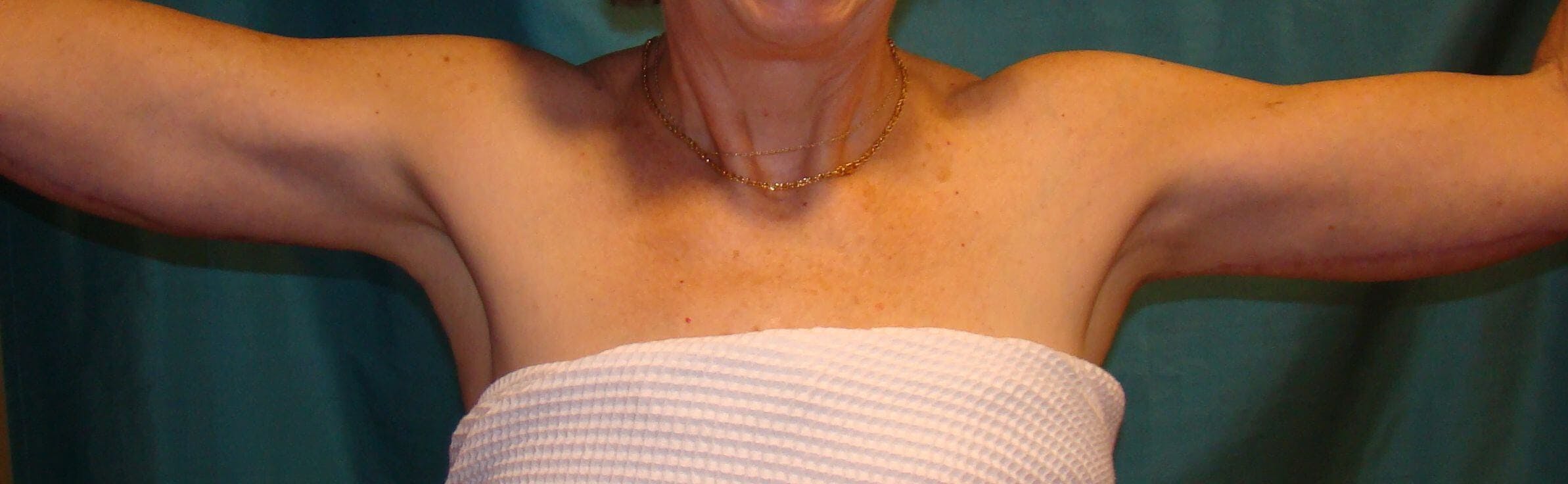 Arm Lift (Brachioplasty) Gallery - Patient 90401987 - Image 2