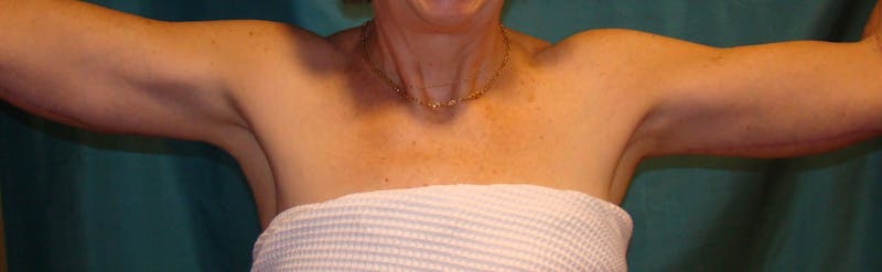 Arm Lift (Brachioplasty) Before & After Gallery - Patient 90401987 - Image 2