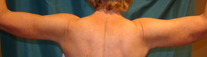 Arm Lift (Brachioplasty) Before & After Gallery - Patient 90401987 - Image 4