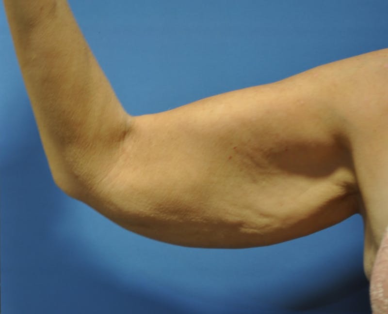 Arm Lift (Brachioplasty) Before & After Gallery - Patient 90401989 - Image 1